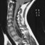Can mathematics help unlock secrets of the spine