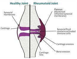 Rheumatoid-joint diagram