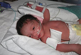 A photograph of a premature baby.