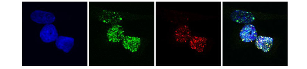 Cancer cells under a microscope