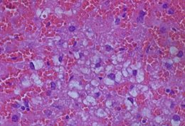 Liver-damage