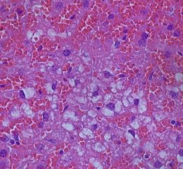 Liver-damage