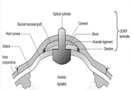 corneal-diagram