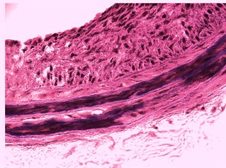Rippling deep pink liquid seen through a microscope illustrating project on locally targeted treatment of cardiovascular disease