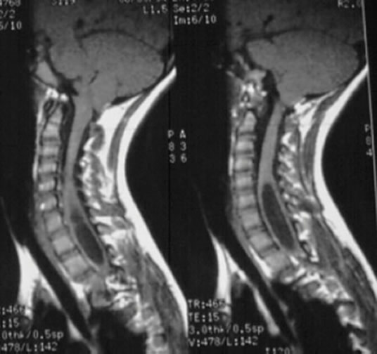 Scan of a deformed spine