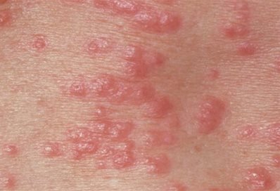 Itchy skin rash, photo by NHS
