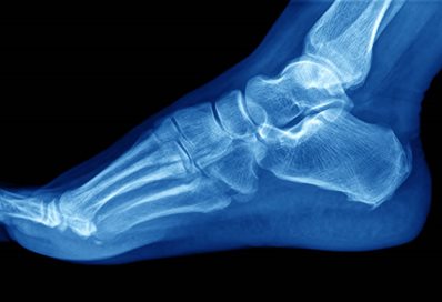 X-Ray of a foot