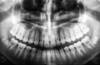 Dental X-rays may increase the risk of thyroid cancer and meningioma