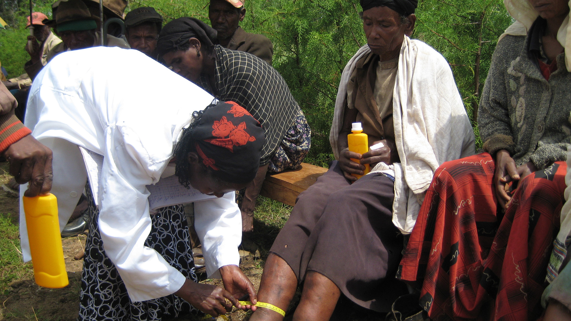 Patients being treated for Podoconiosis in Africa