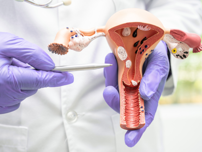 Doctor's hands holding a model of he womb to illustrate cancer growth
